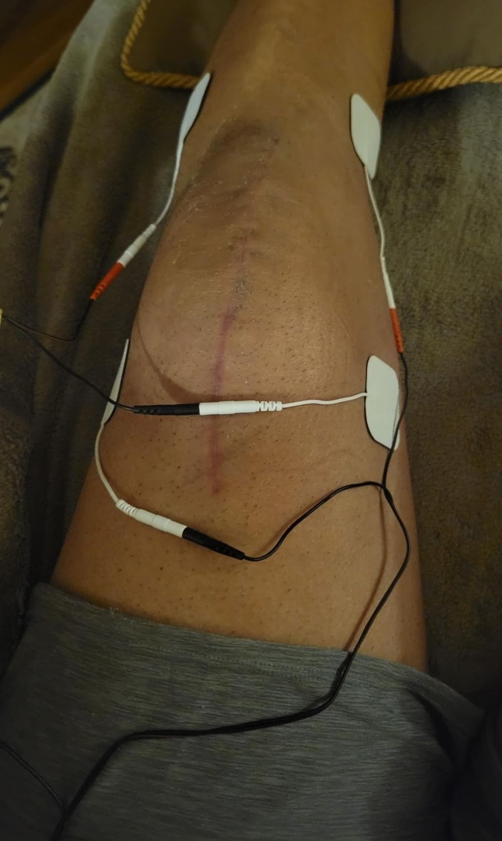 Therapist’s Choice Digital TENS Unit – Professional Pain Relief at Home - Image 3